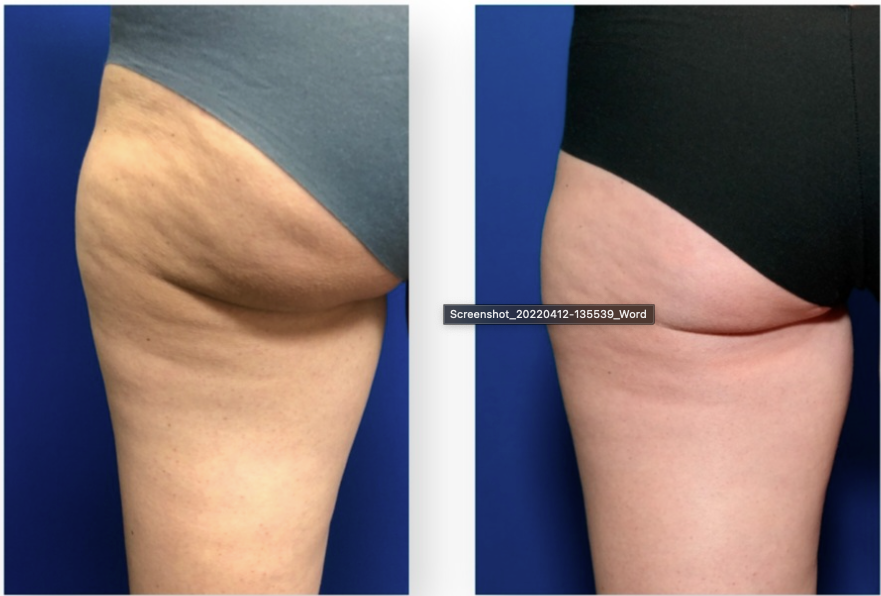 Cellulite Removal Treatment in Tampa