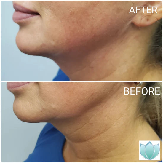 Skin Tightening before and after at Fusion MediSpa