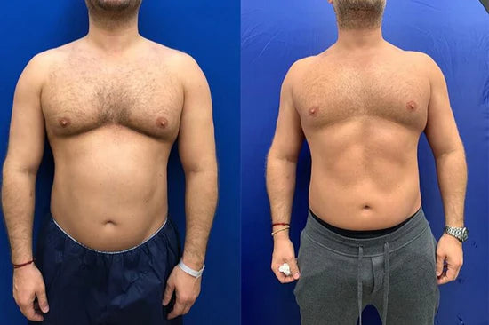 For Dad! Tight & Strong Package – Emsculpt NEO®
