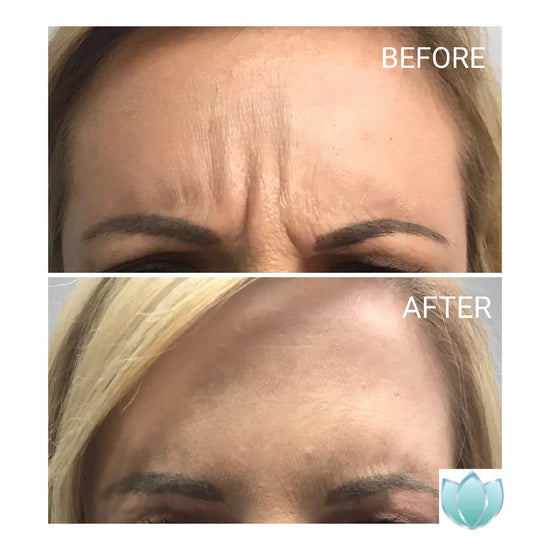 Botox before and after at Fusion MediSpa
