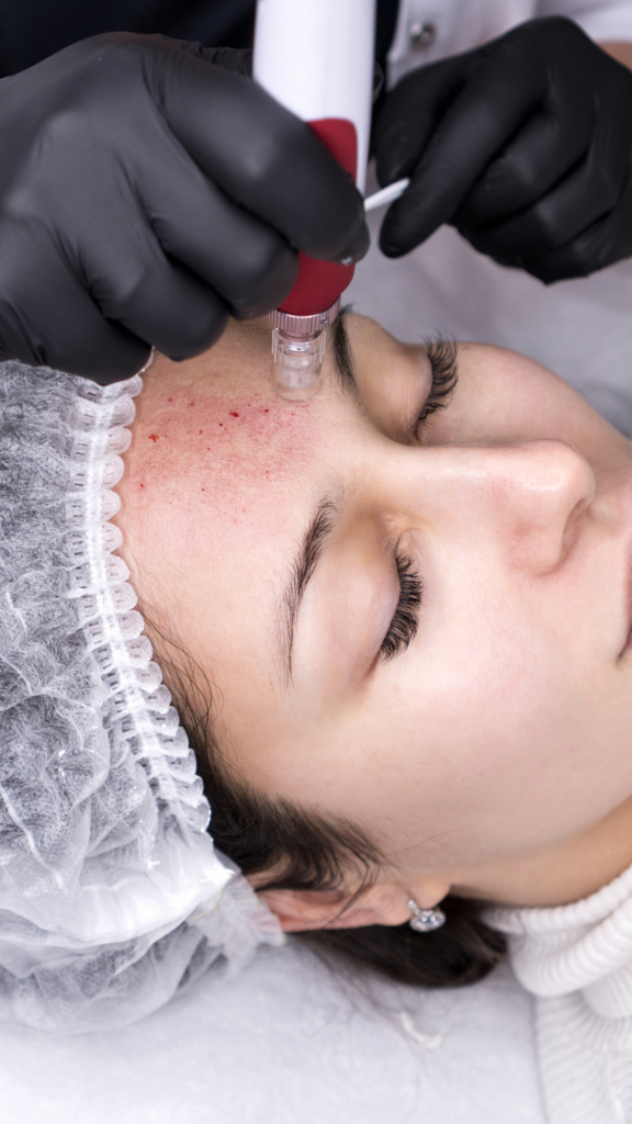 Renew Dermal Peel by Factor Five