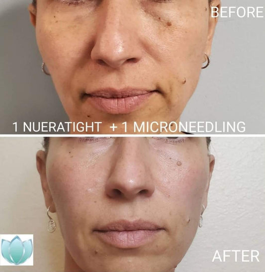 Skin Tight Treatment