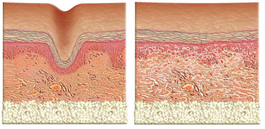 Belotero Balance® Treatment