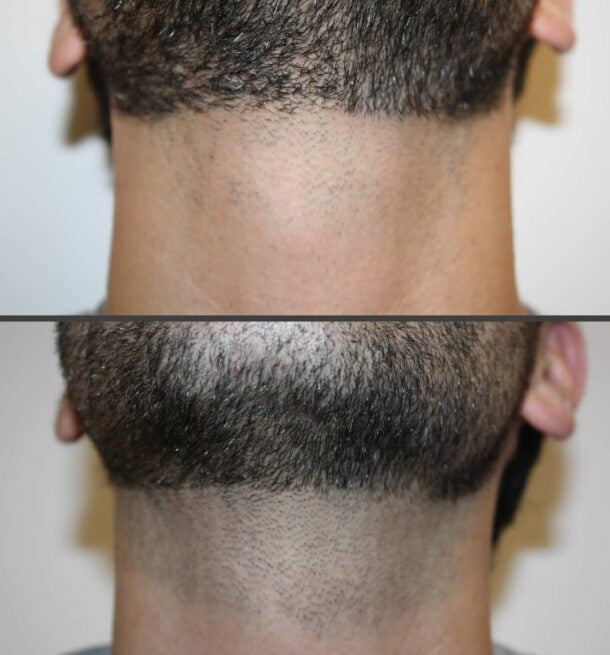 Unlimited Laser Hair Removal