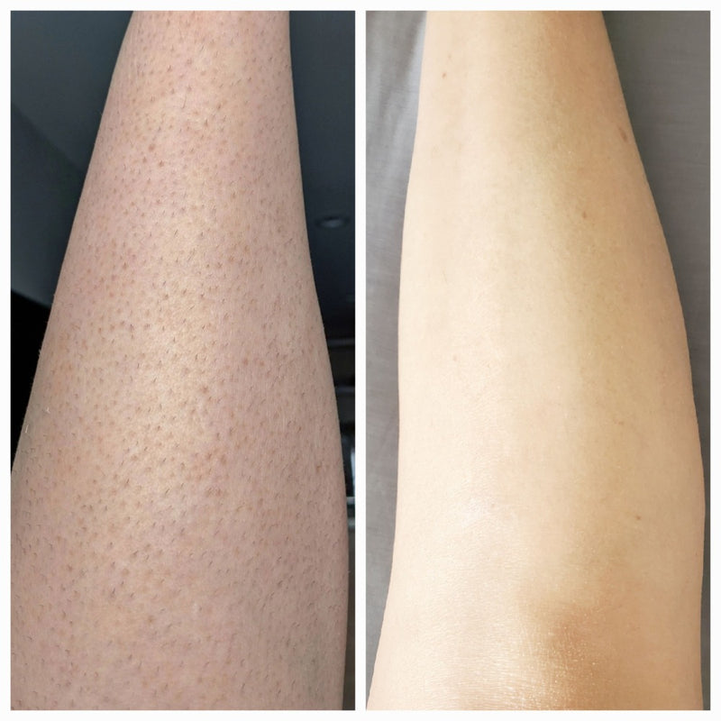 Laser Hair Removal before and after at Fusion MediSpa