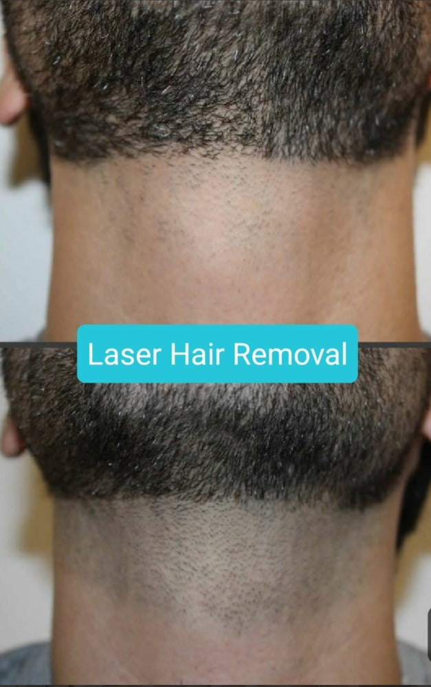 LASER HAIR REMOVAL MEMBERSHIP SMALL AREA